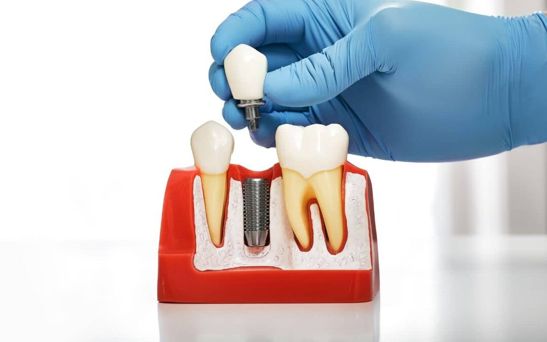 Pode haver rejeição no implante dental?